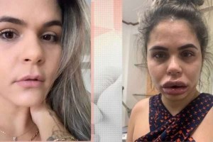 Mulheres ficaram deformadas após promessa de harmonização facial    Foto: Reprodução/TV Globo